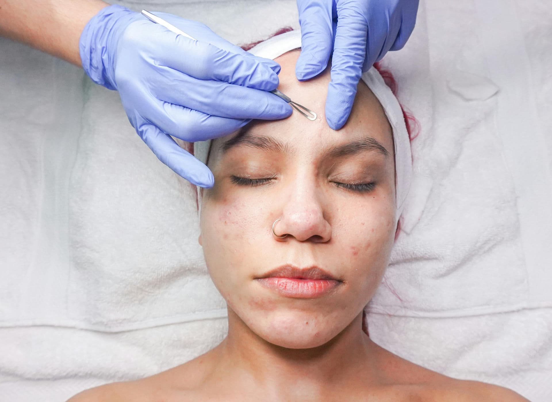 Acne Treatment